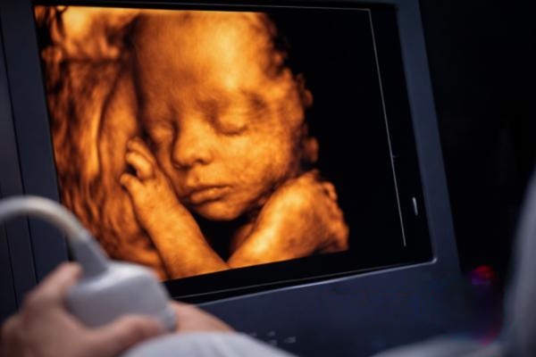 3D/4D Sonography